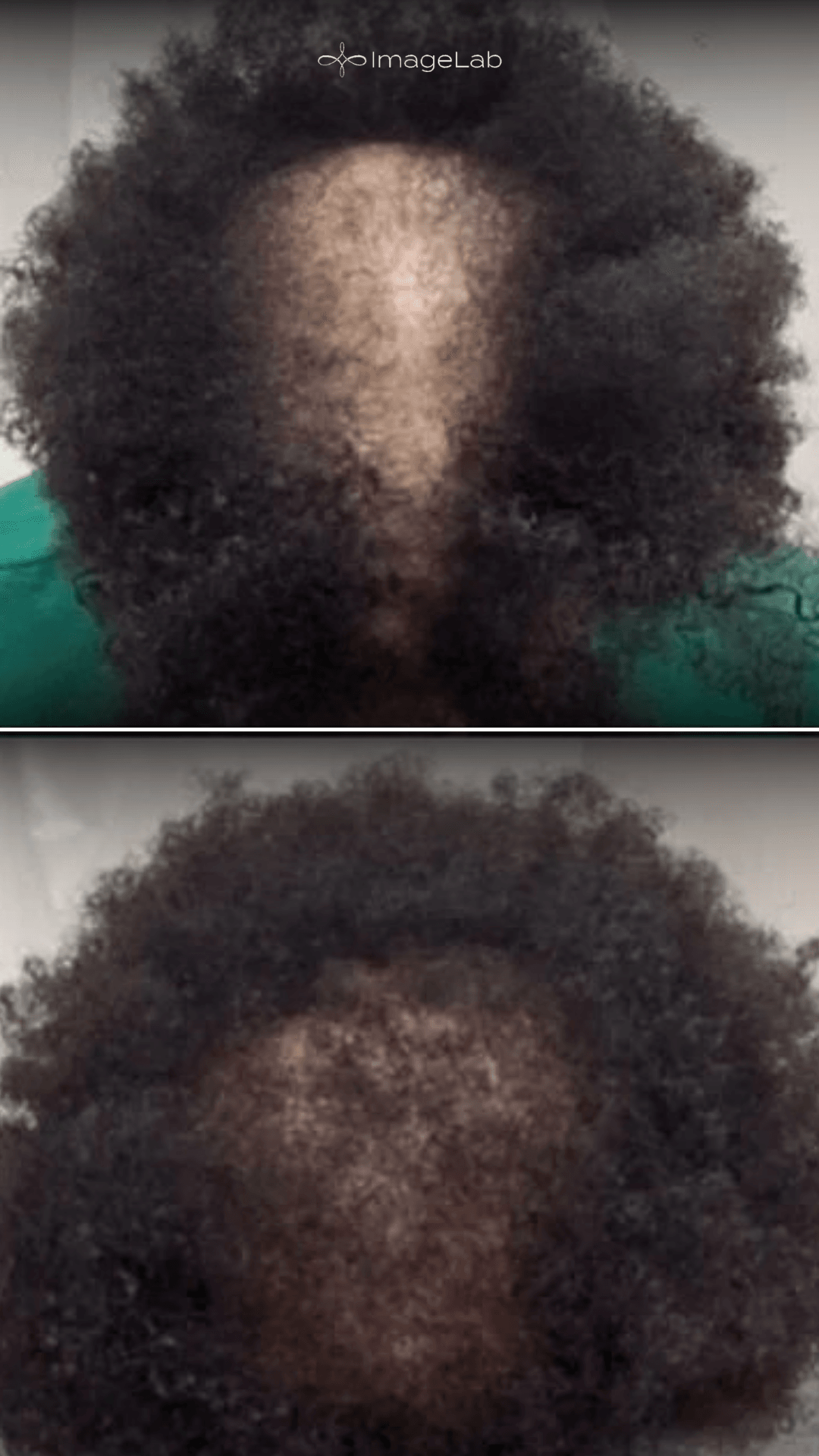 Before and after result