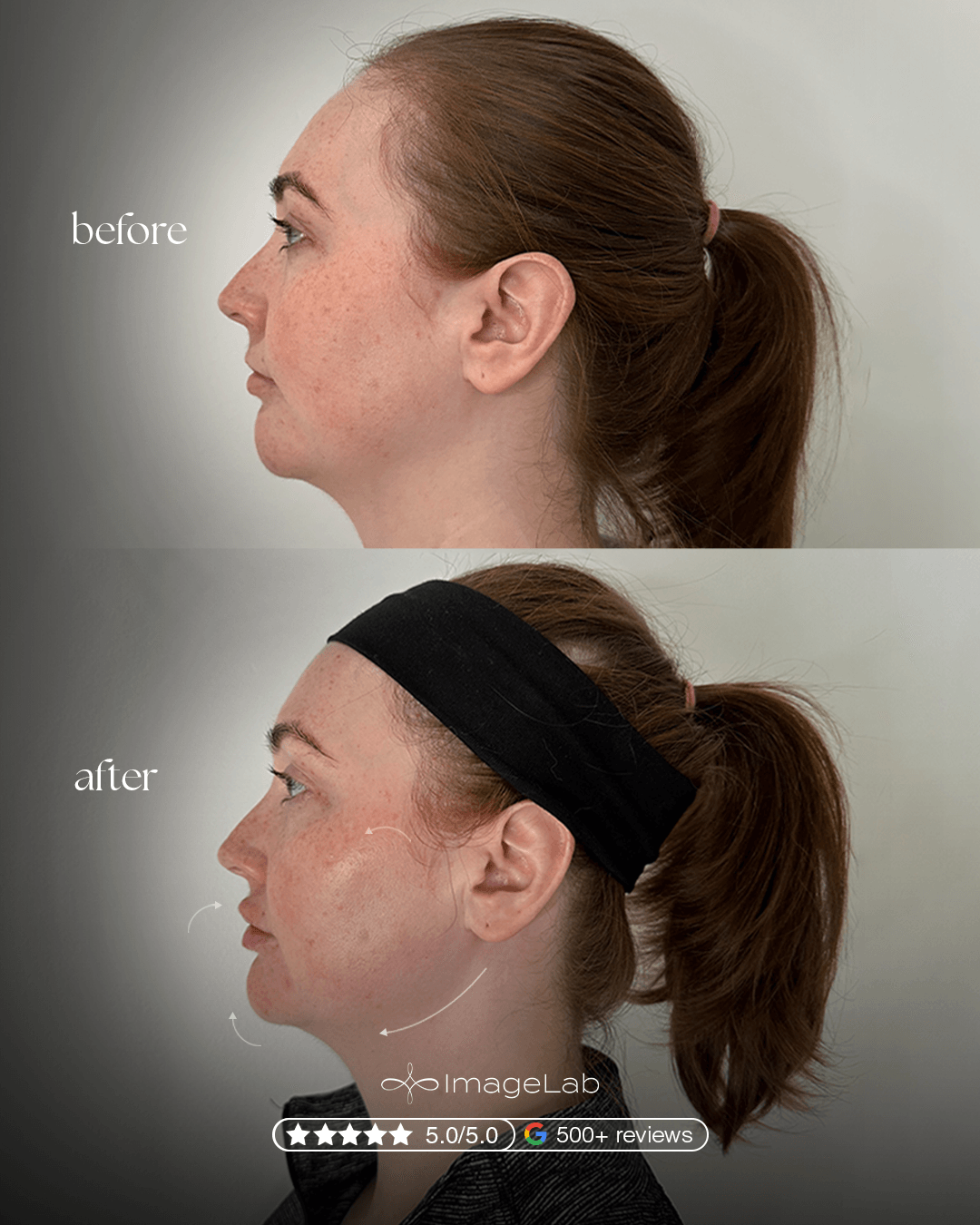 Before and after result
