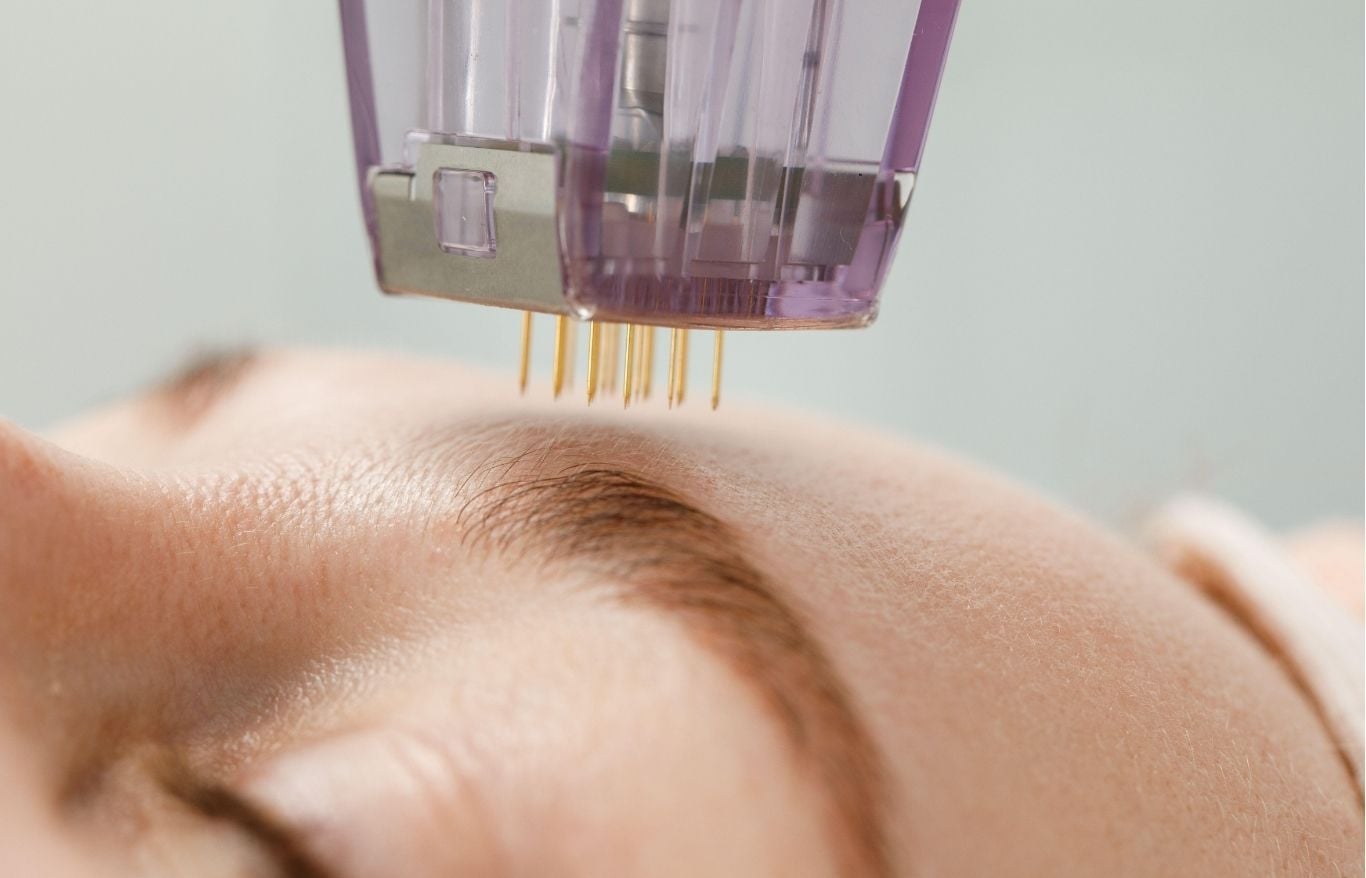 microneedling alexandria va