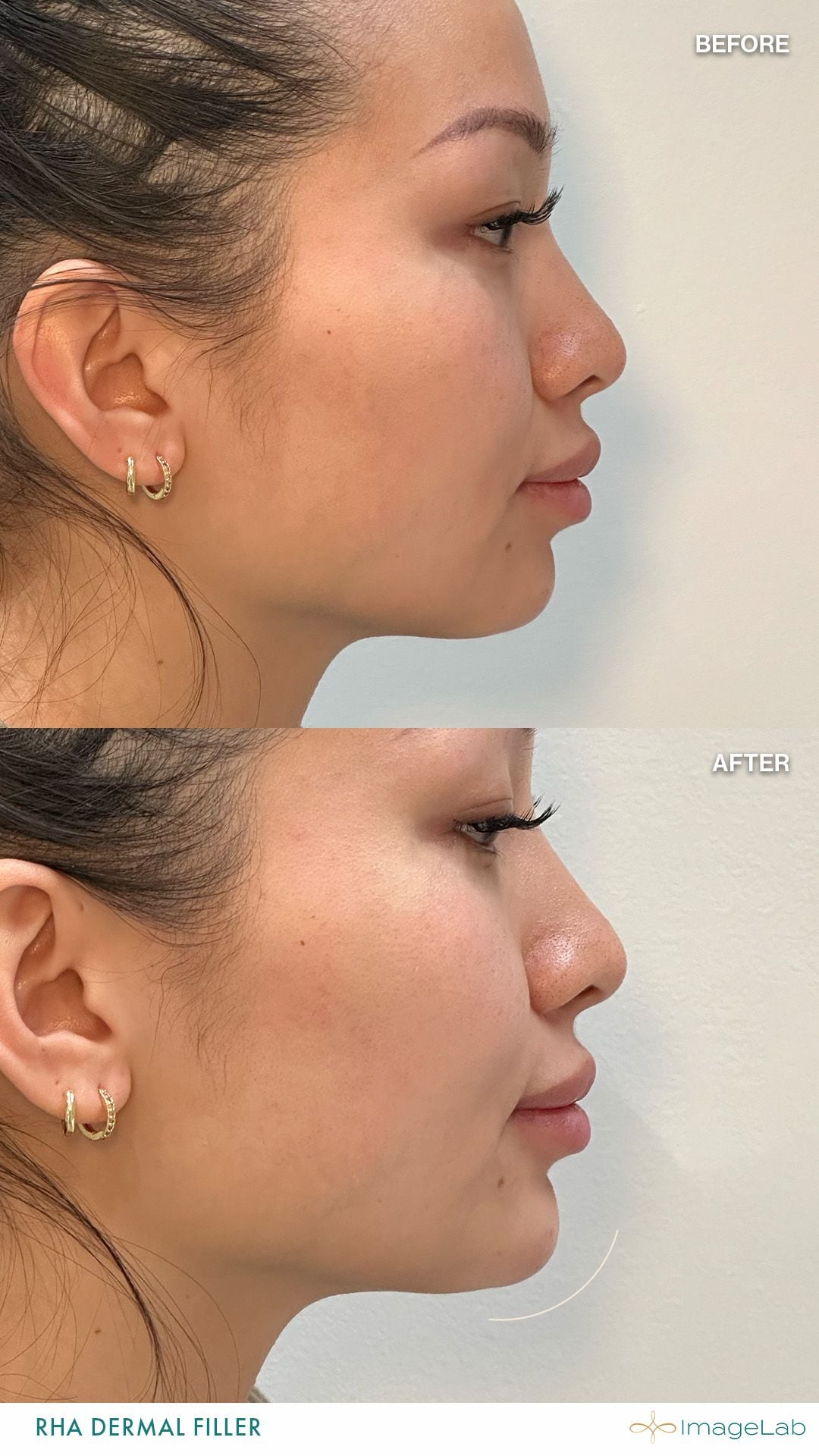 Before and after result