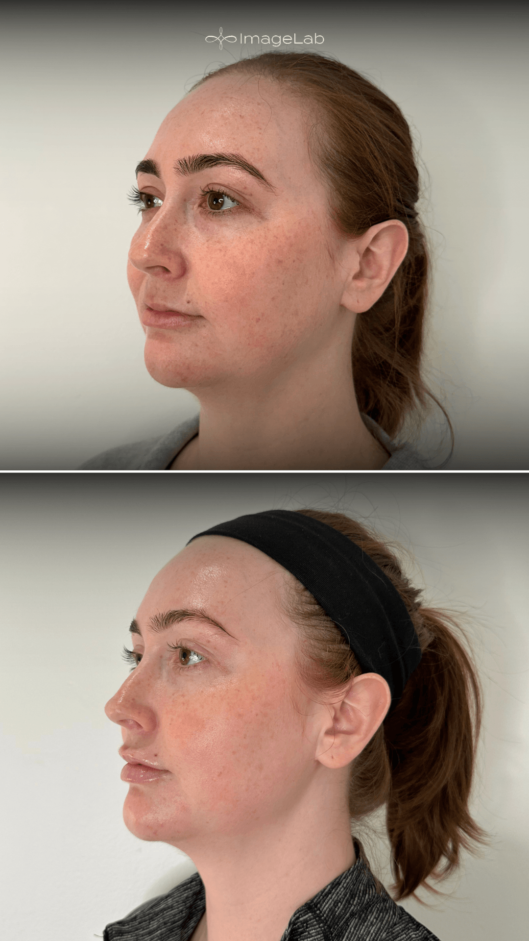 Before and after result