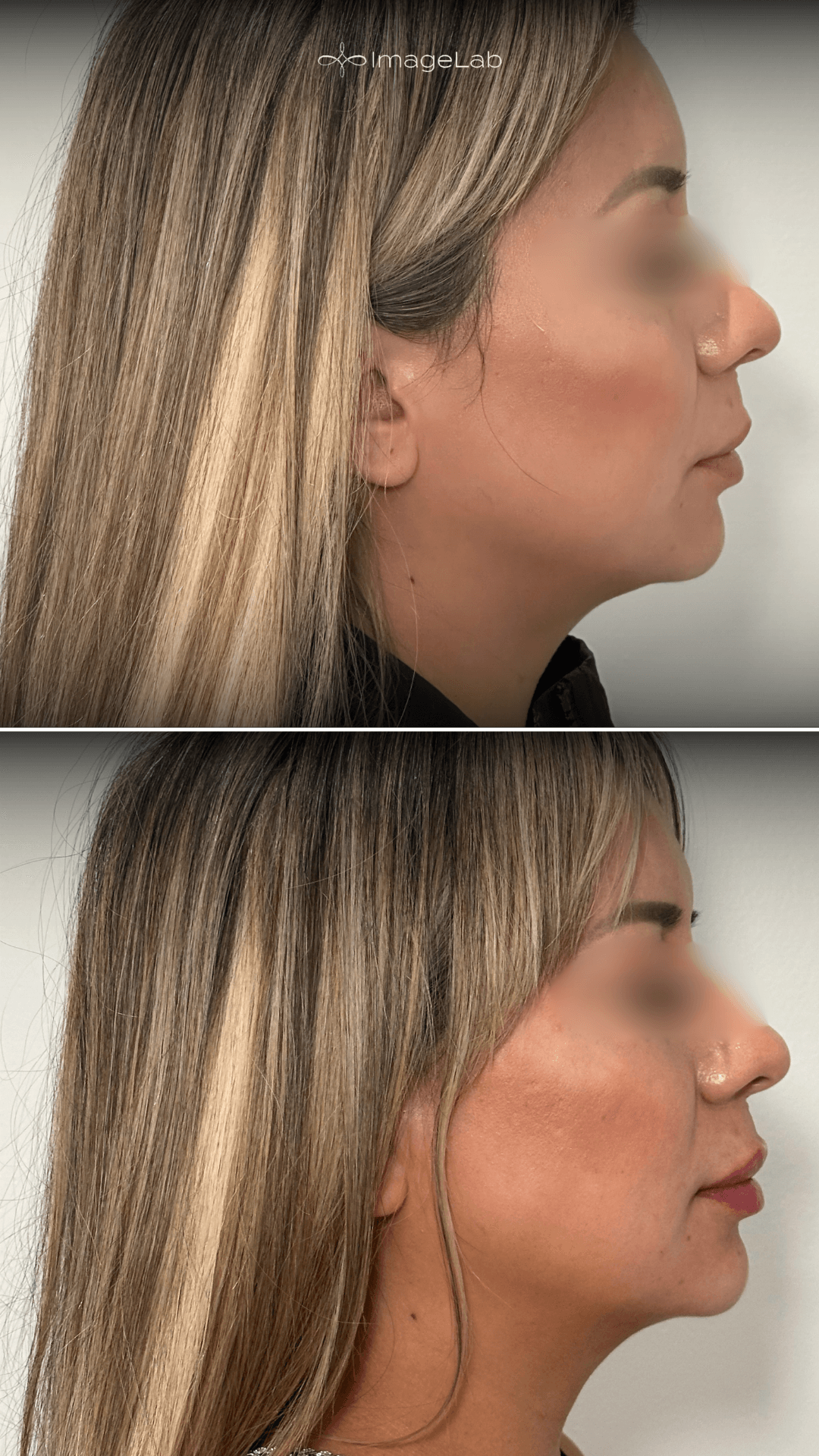 Before and after result