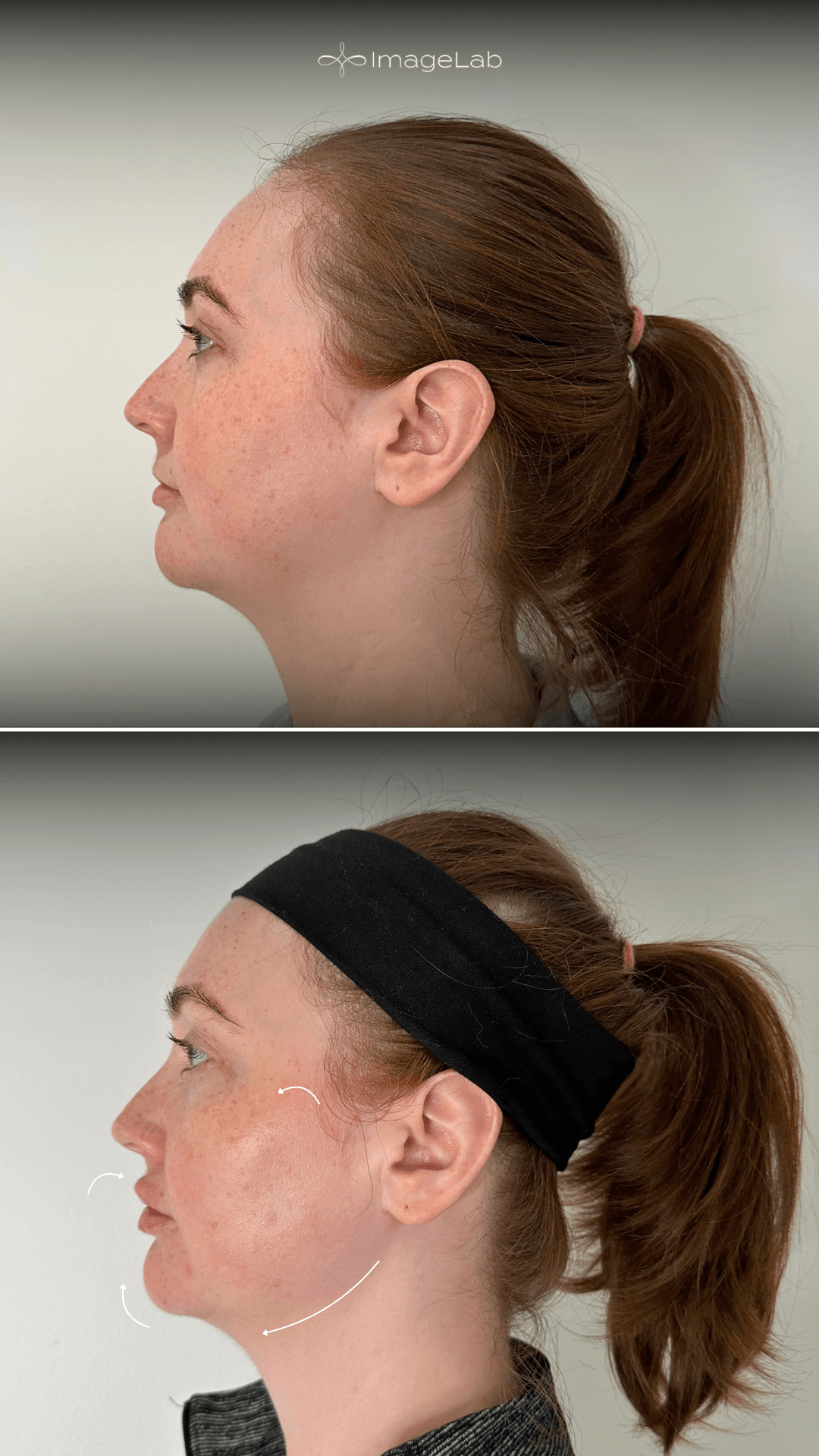 Before and after result