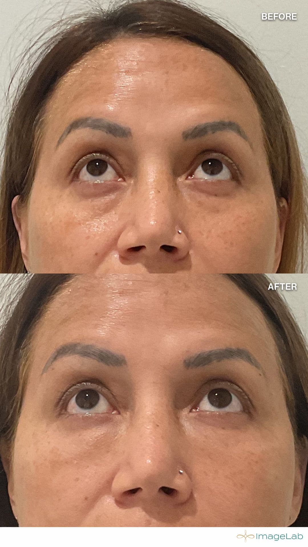 PRP Filler result at ImageLab Med Spa