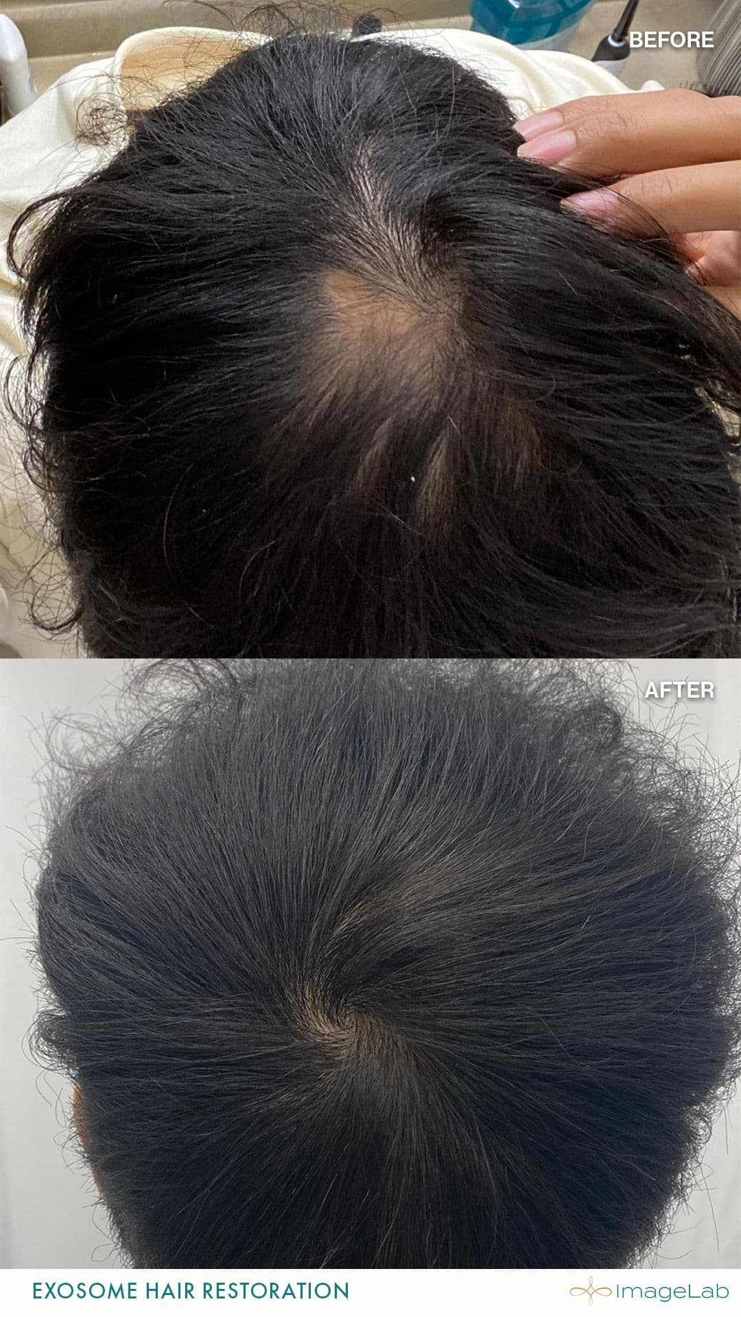 Exosome Hair Restoration result at ImageLab Med Spa