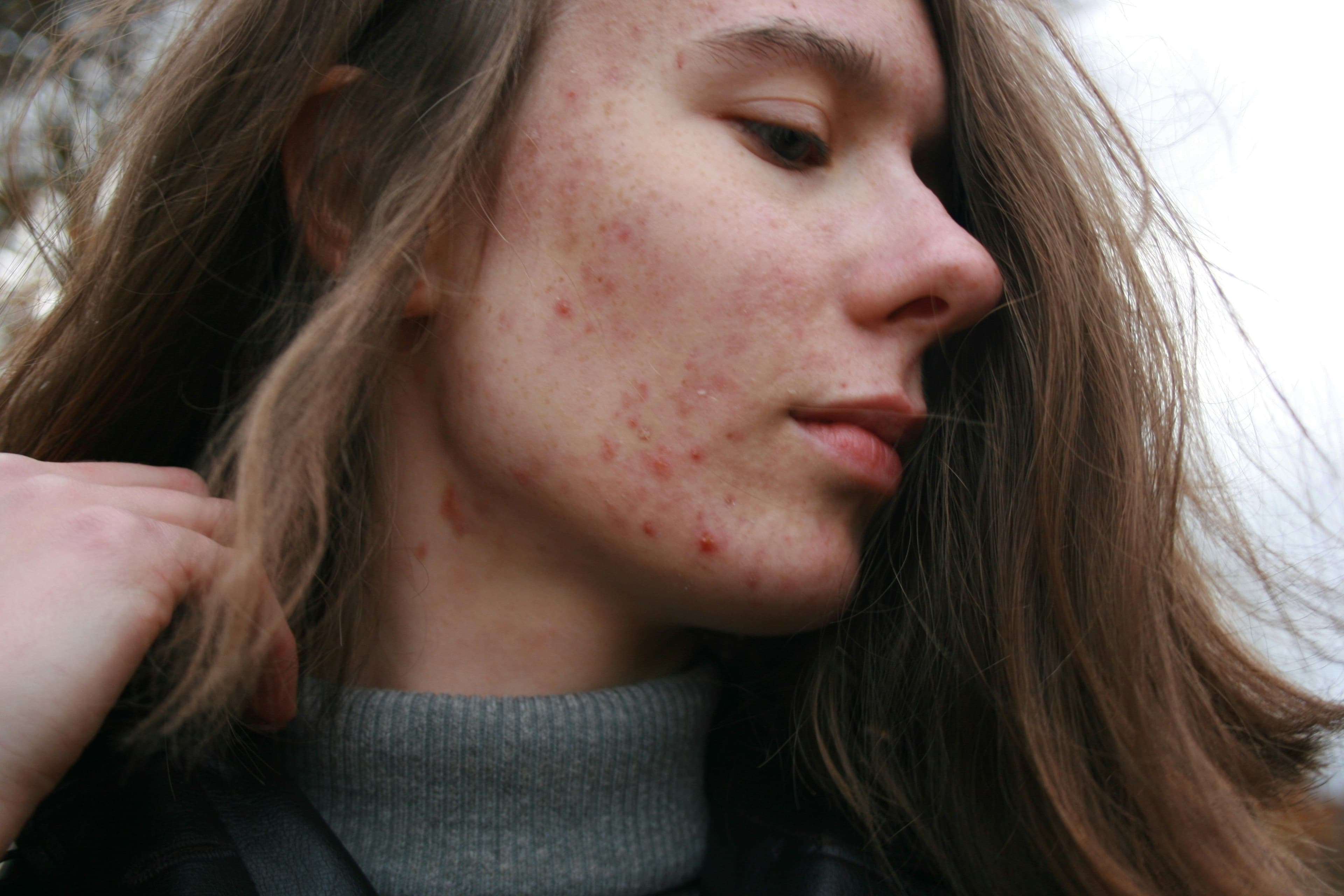 Acne Scarring