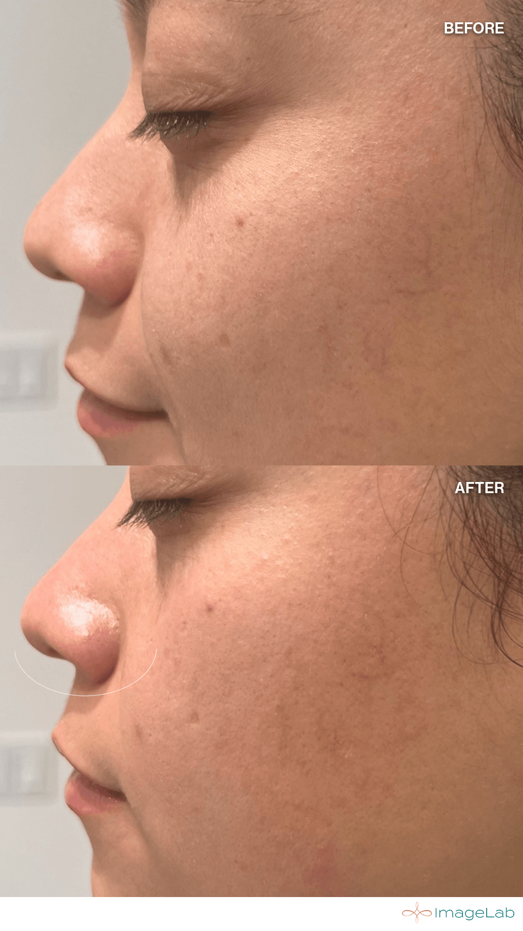 Before and after result