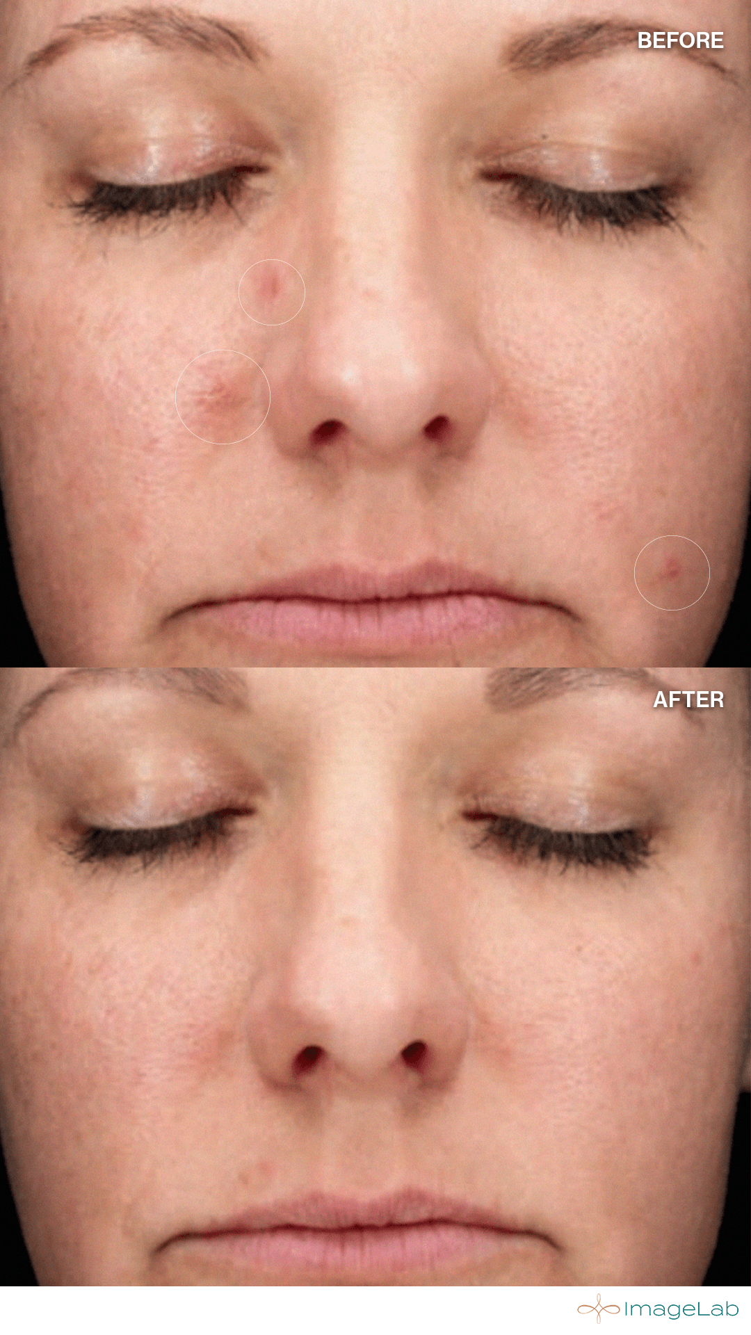 Chemical Peels result at ImageLab Med Spa