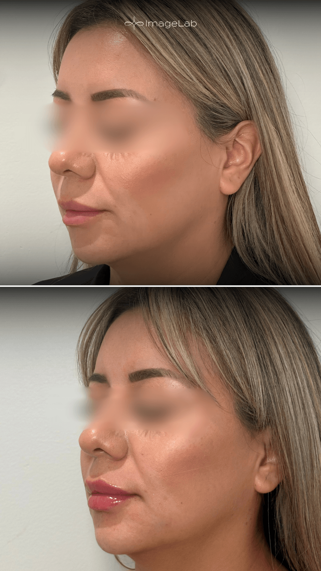 Before and after result