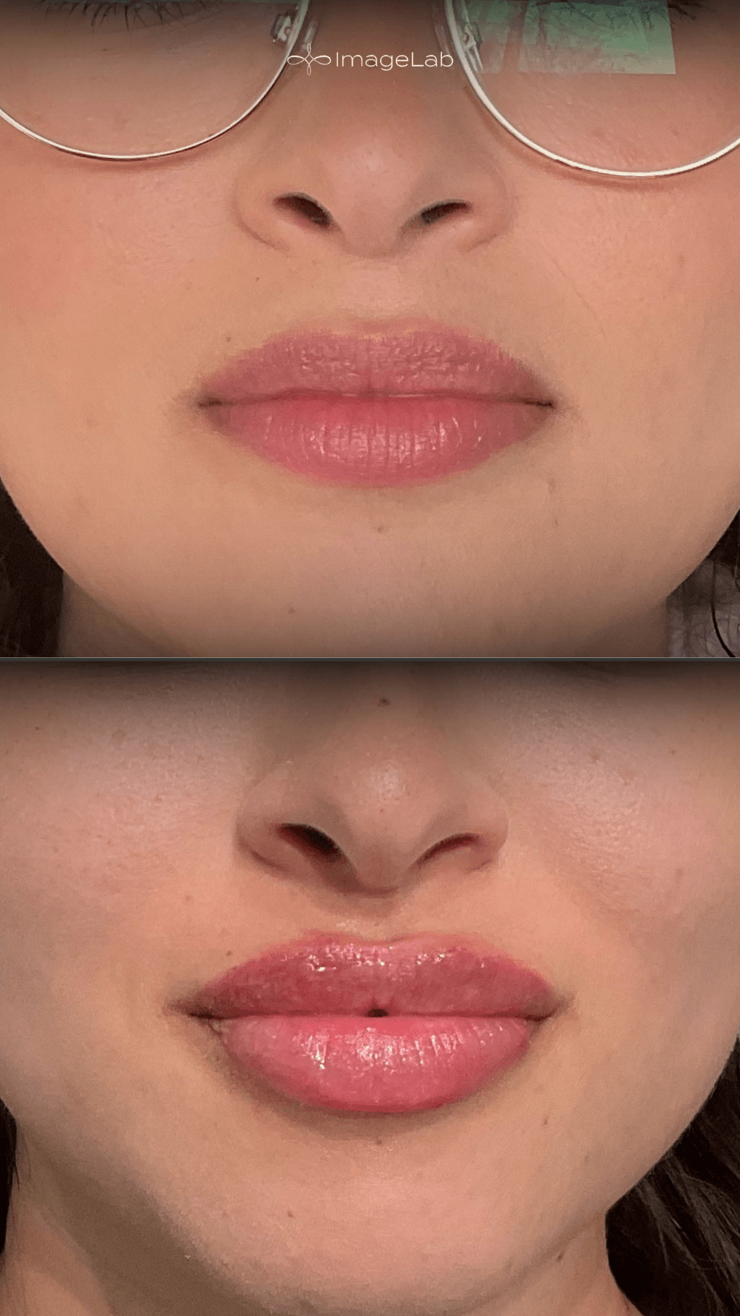 Before and after result