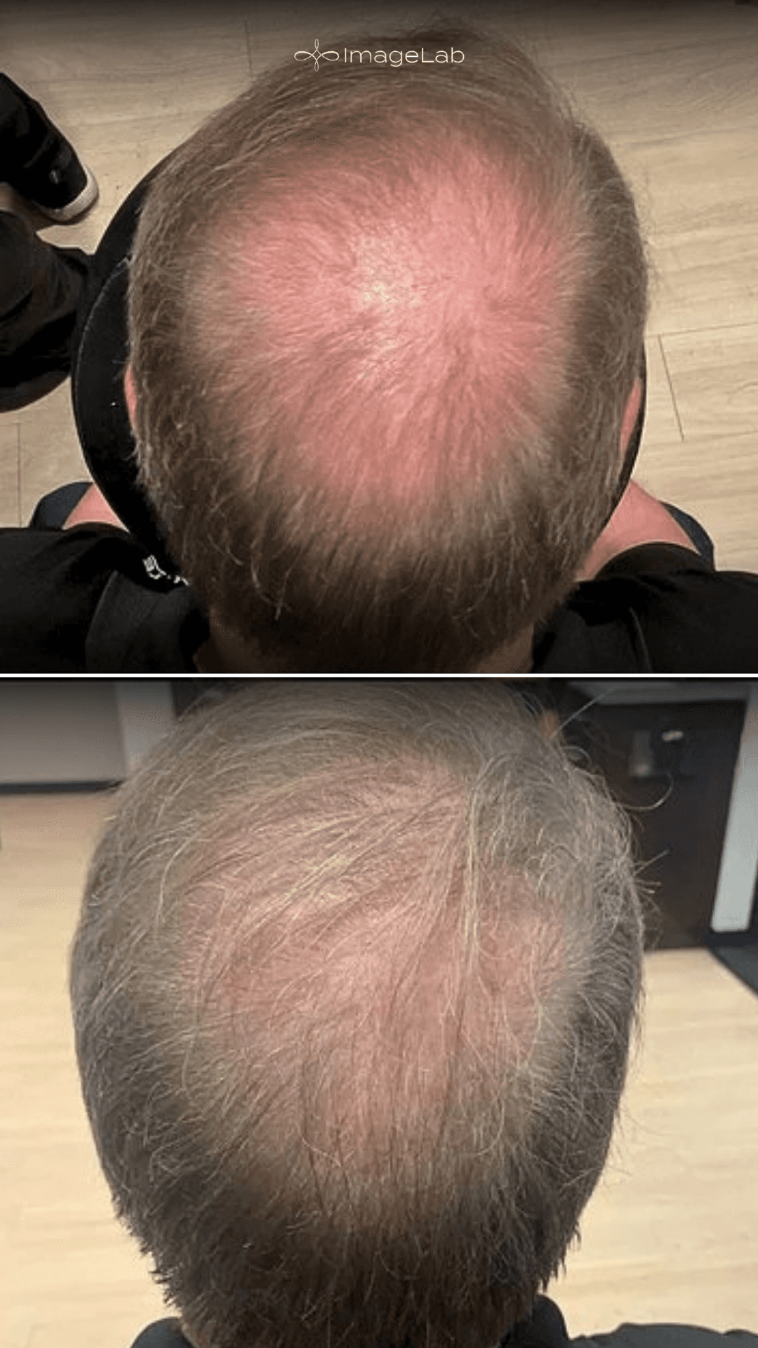 Exosome Hair Restoration result at ImageLab Med Spa