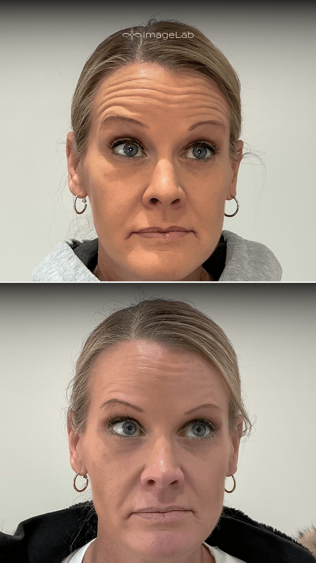 Before and after result