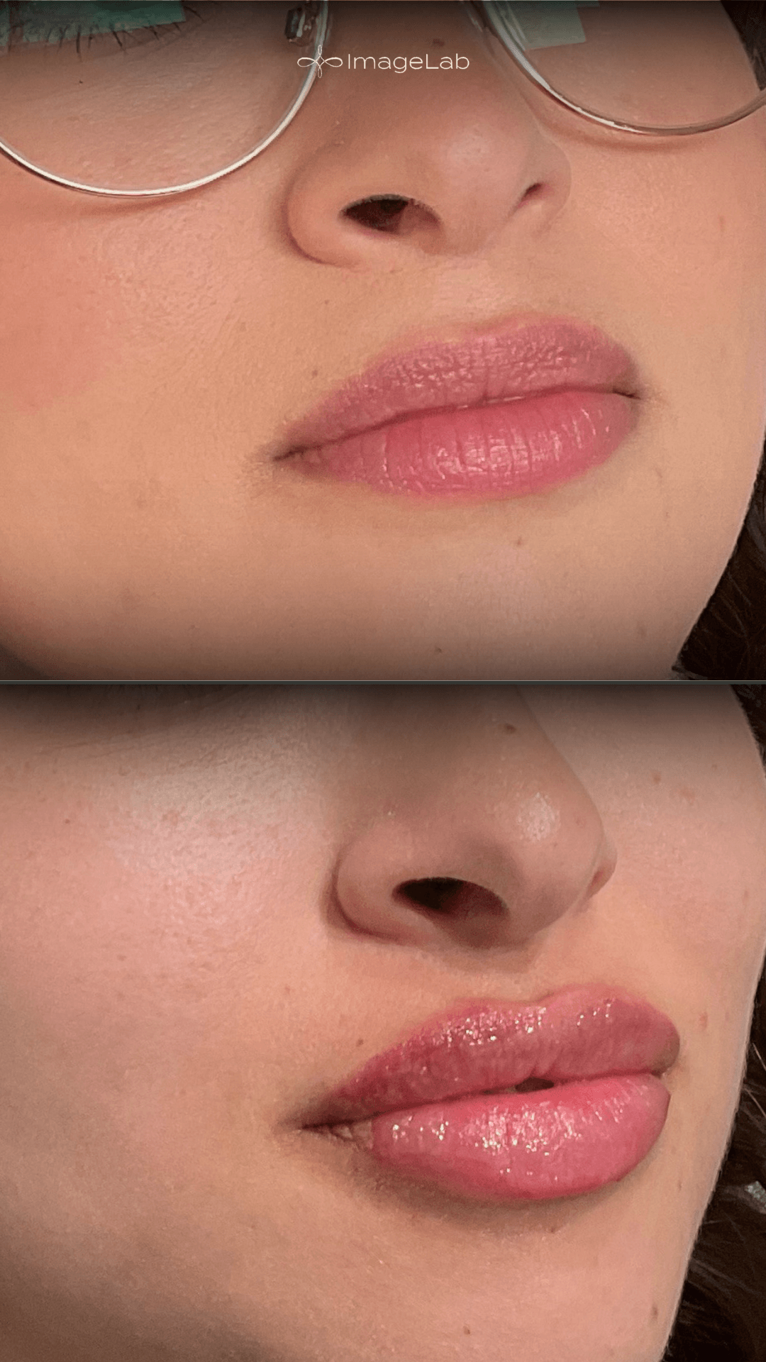 Before and after result