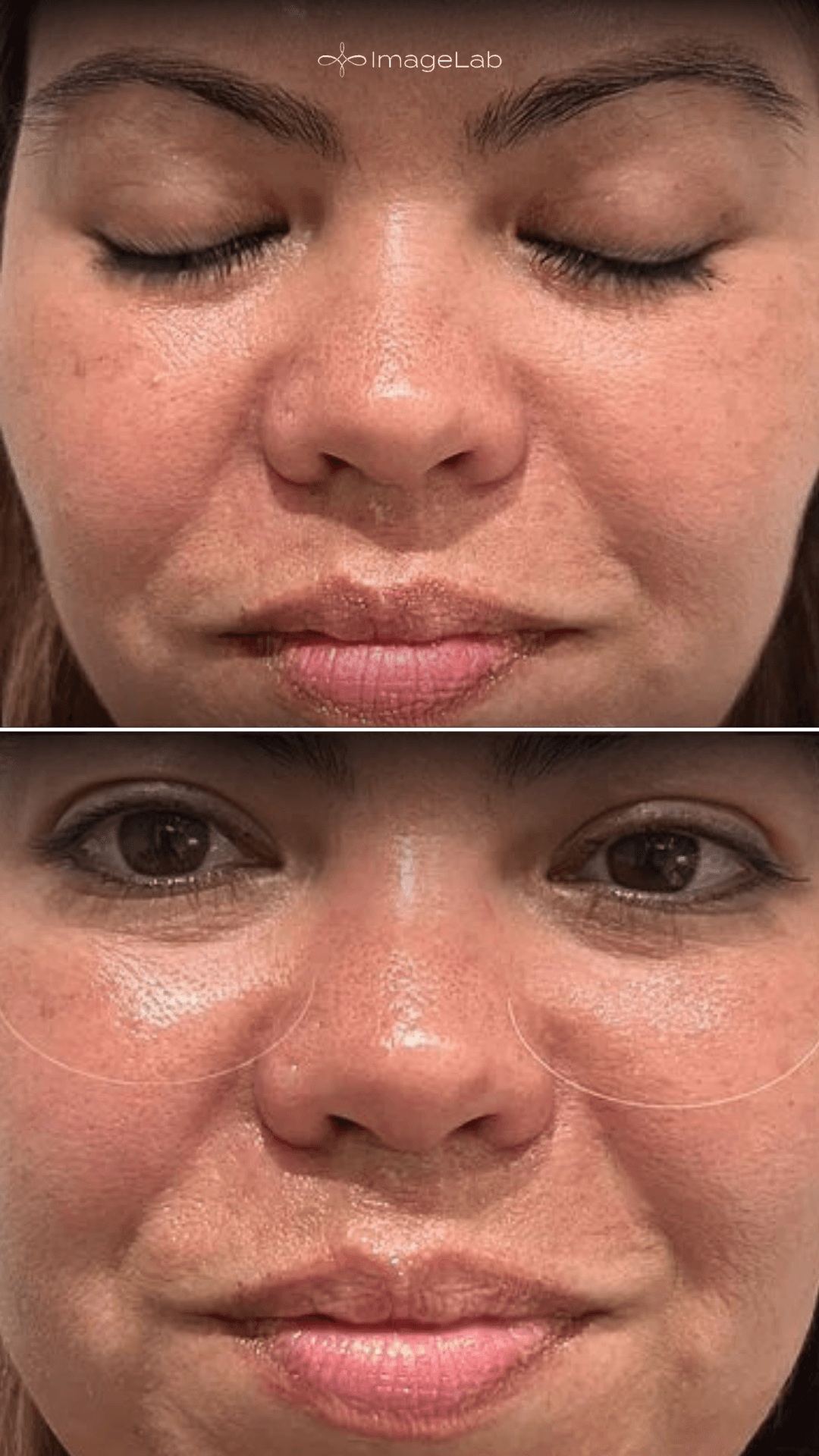 Before and after result