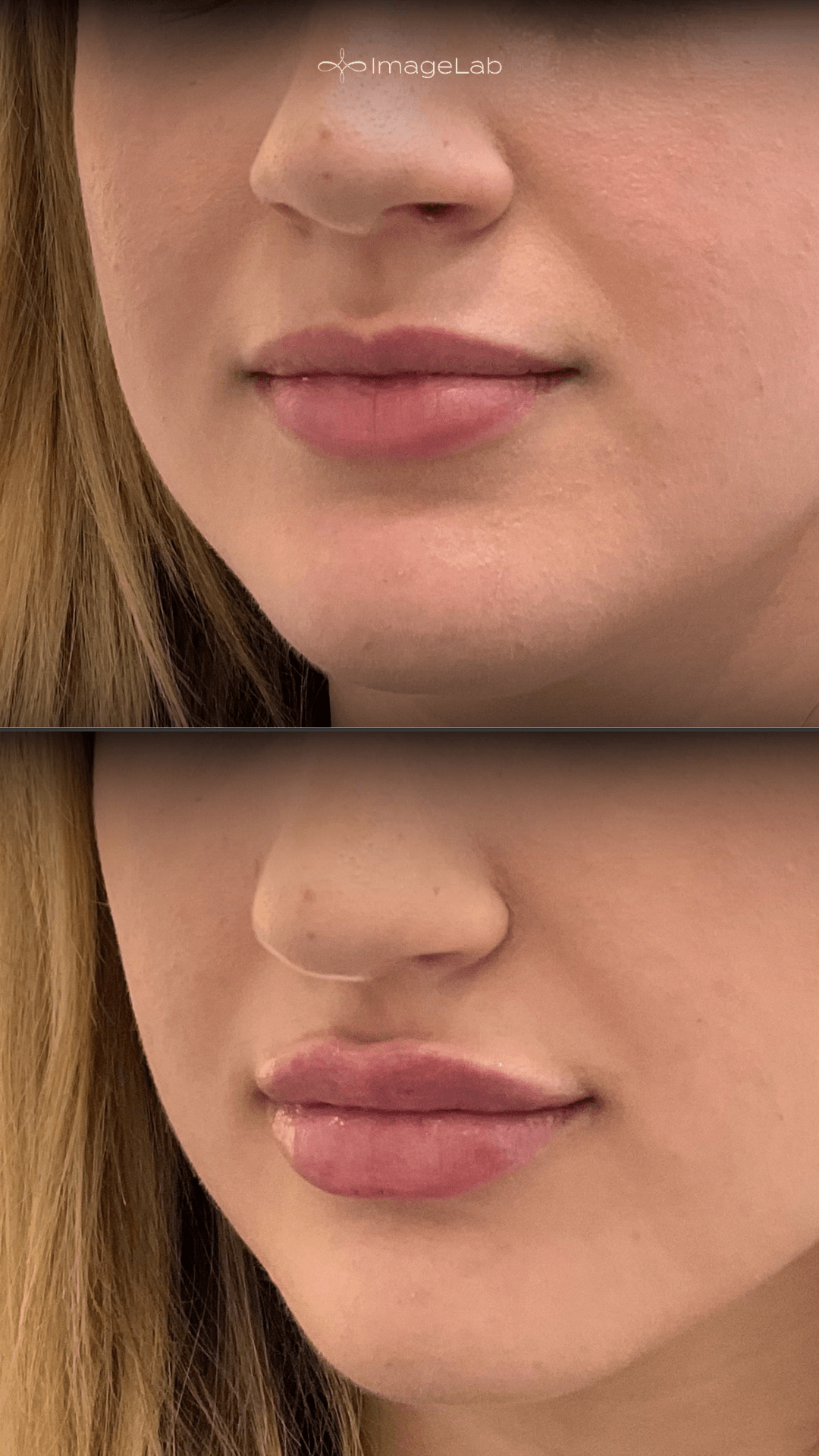 Before and after result