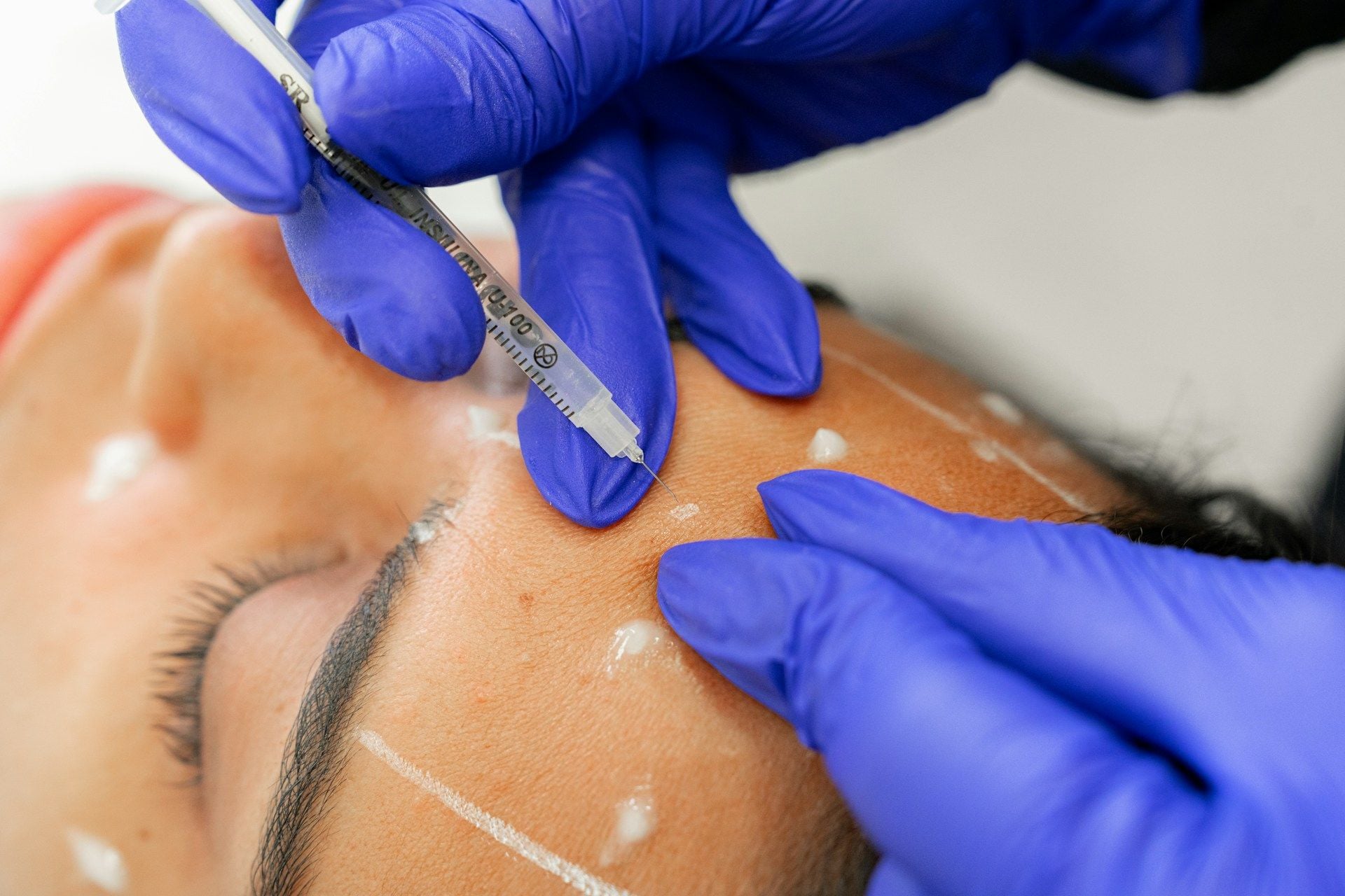 Practitioner administering a forehead injection wearing blue gloves.