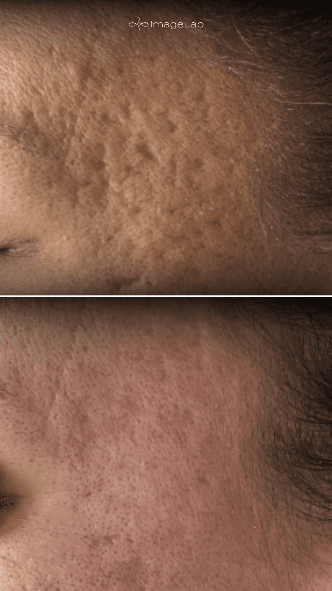 Microneedling result at ImageLab Med Spa