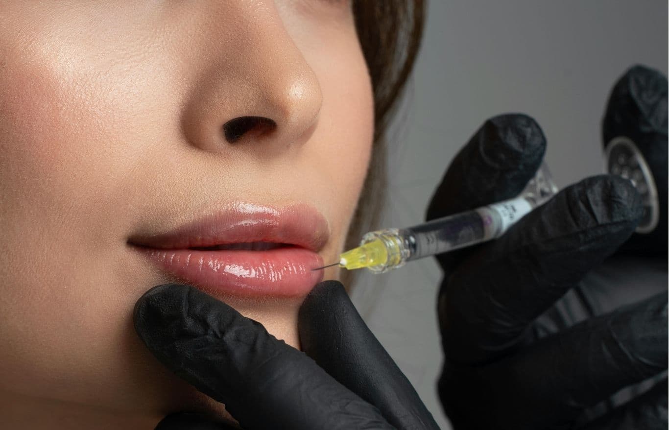 lip fillers injections rockford il
