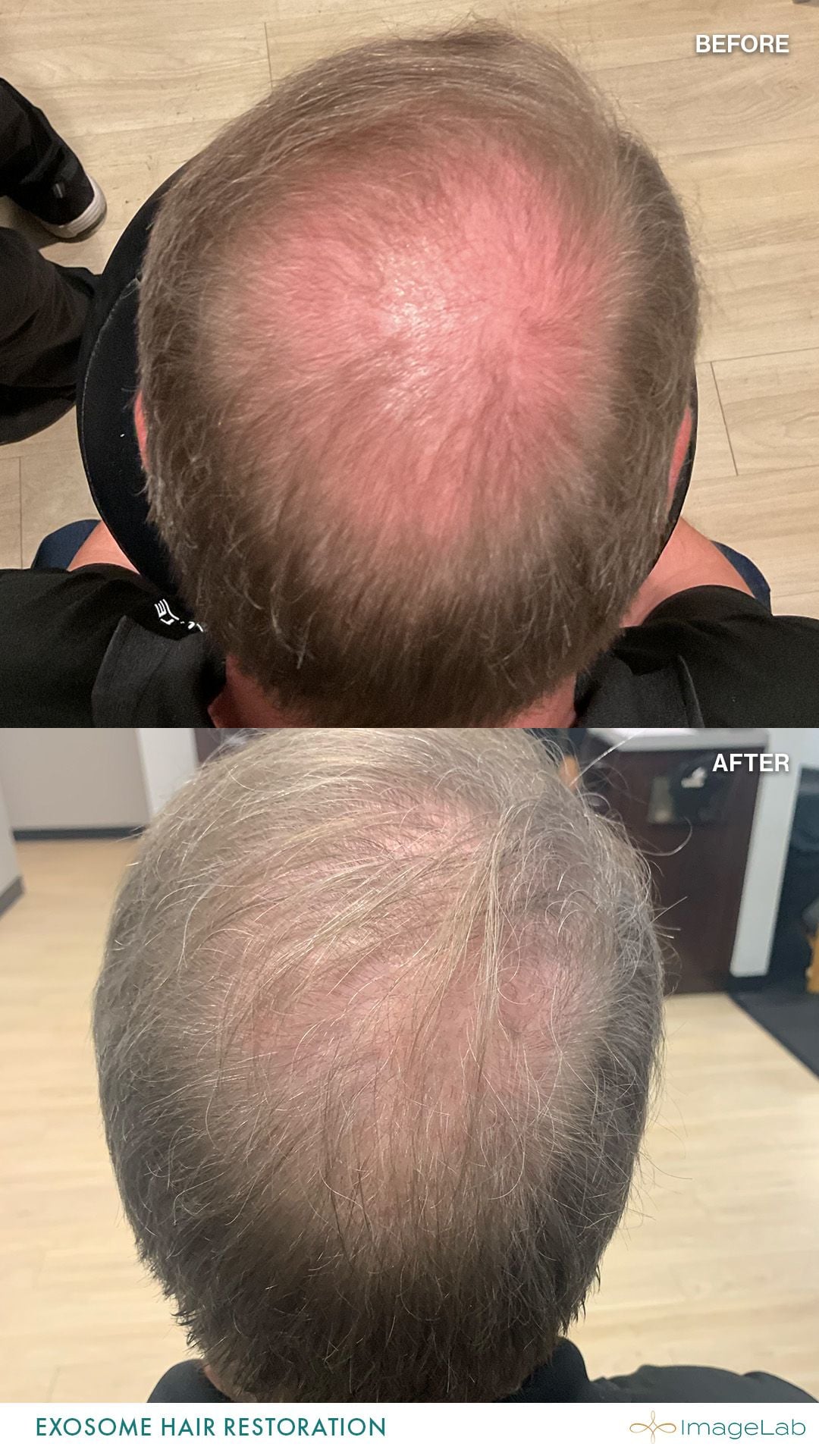 Before and after result
