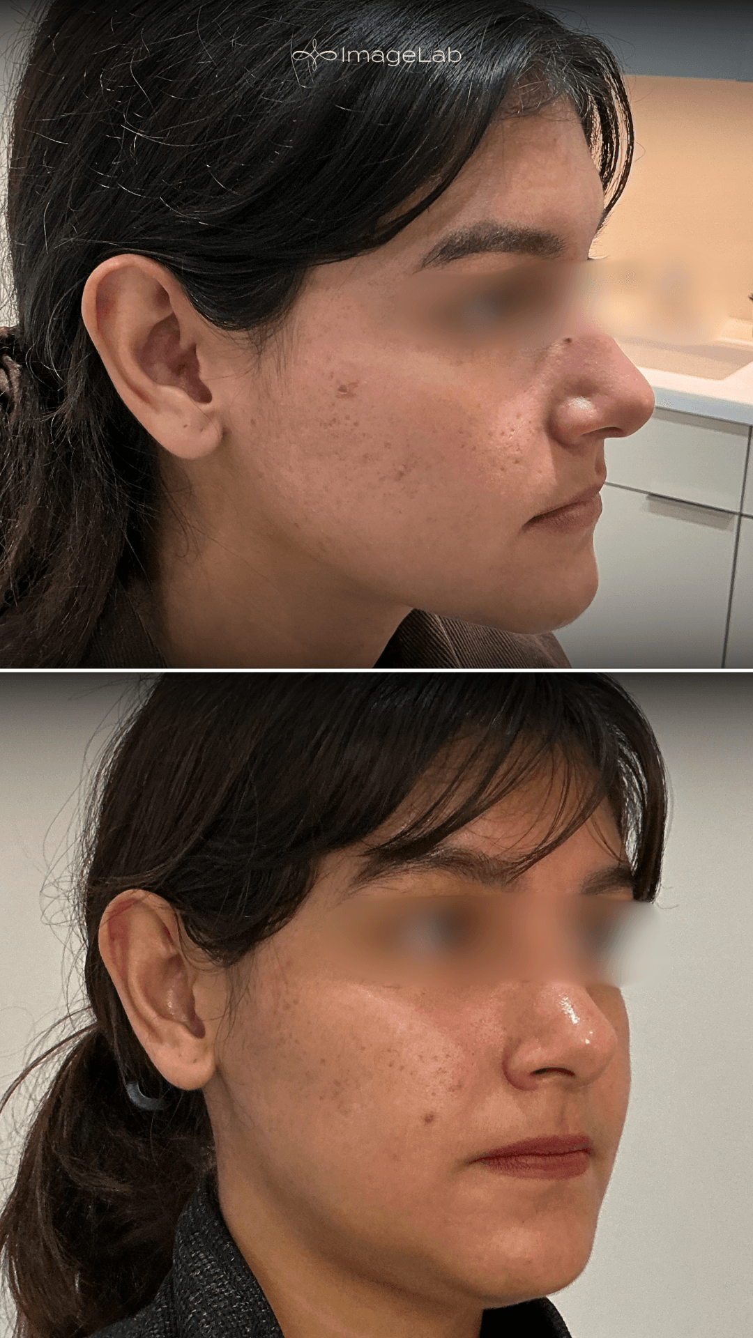 Before and after result