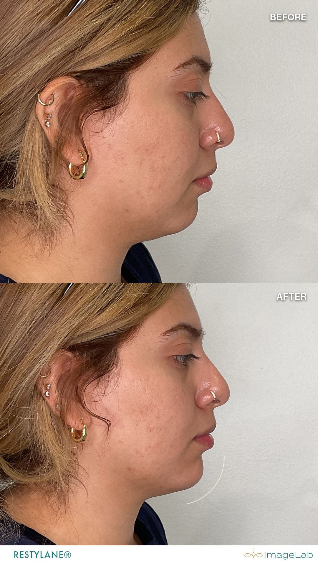 Before and after result