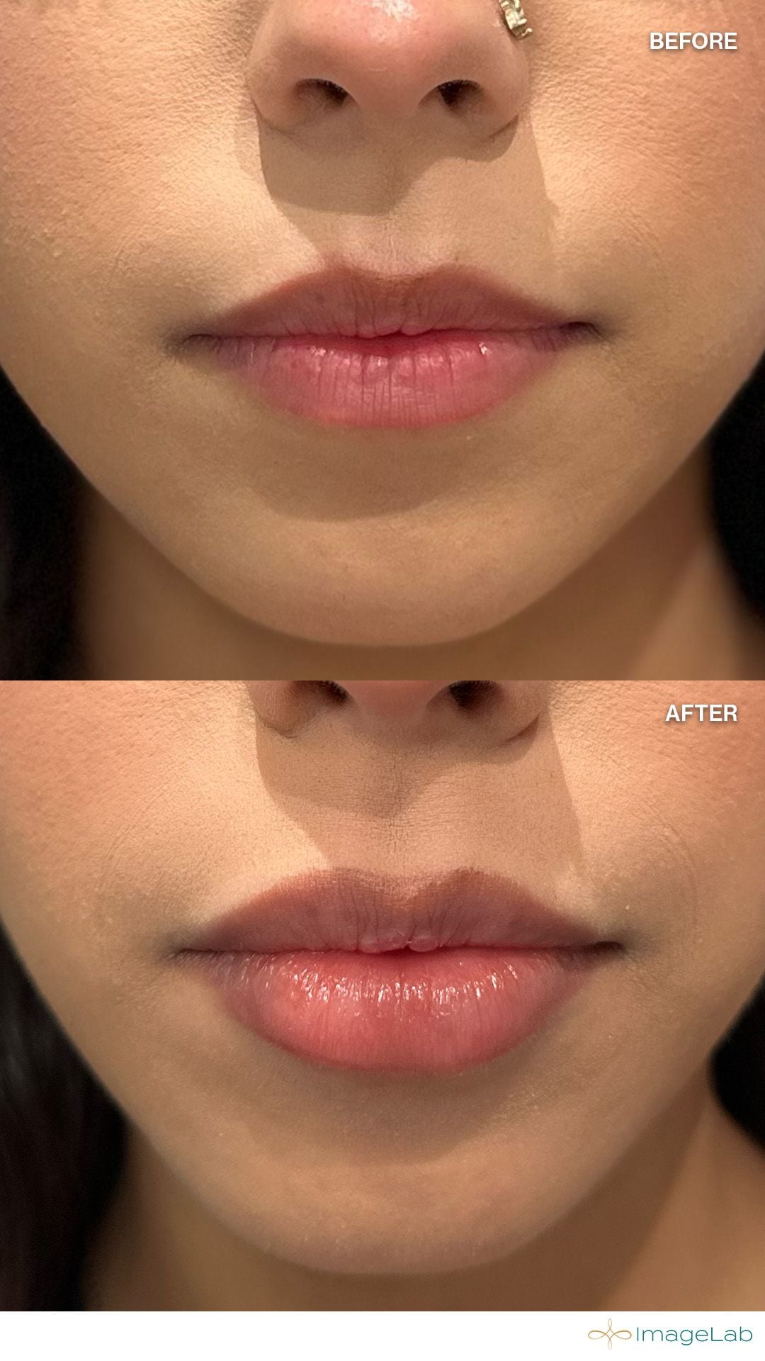Before and after result