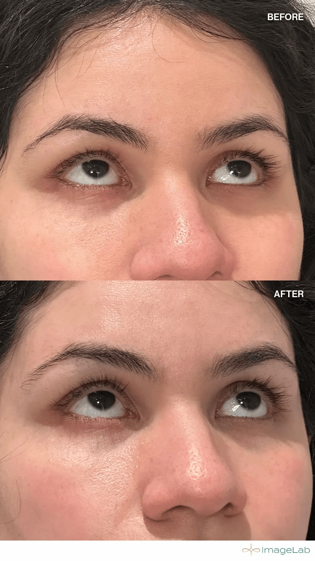 PRP Injections for Face