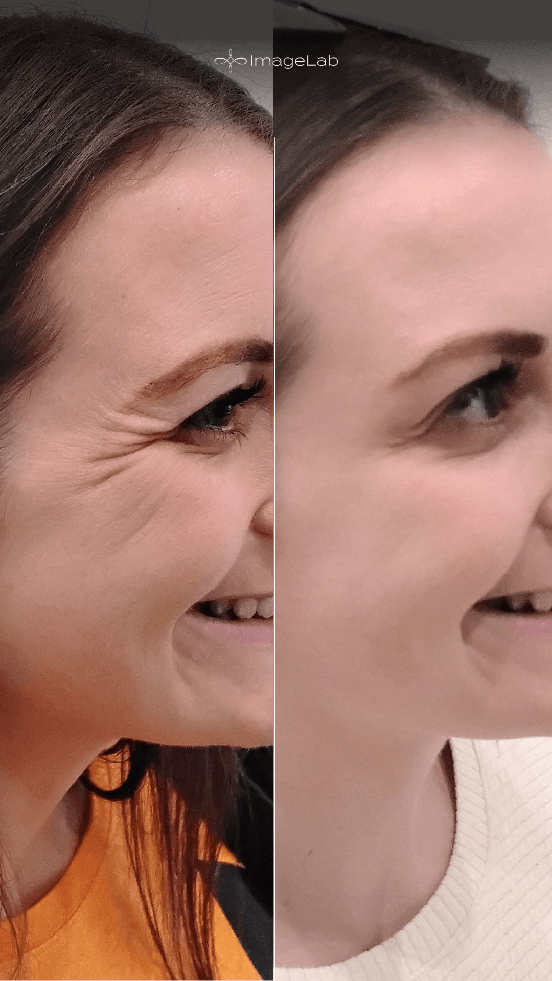 Before and after result